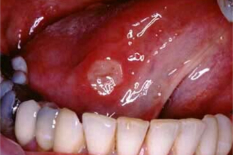 白塞病舌侧有个溃疡图