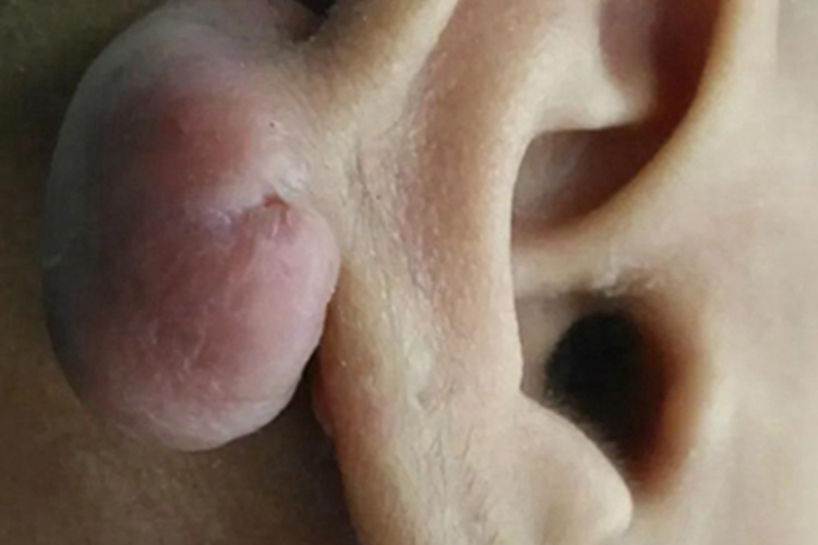 瘢痕疙瘩耳部长肉疙瘩图 瘢痕疙瘩耳部长肉疙瘩图