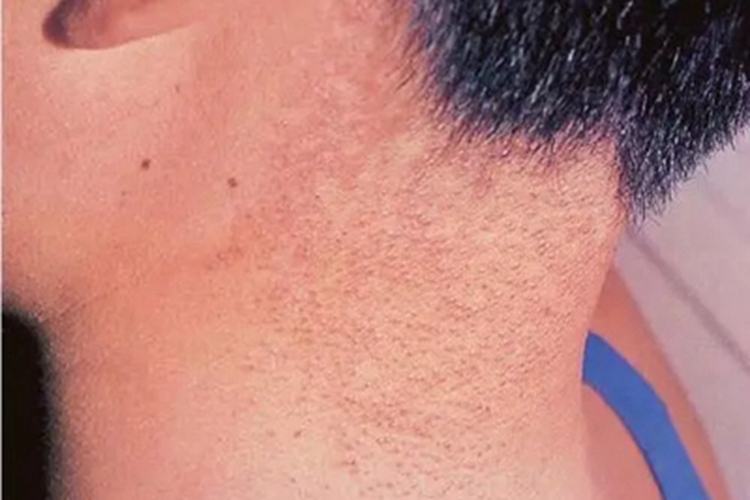 面颈部毛囊红斑黑变病侧颈丘疹图 面颈部毛囊红斑黑变病侧颈丘疹图