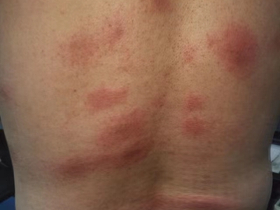 荨麻疹型药疹背部有大块红斑图.jpeg