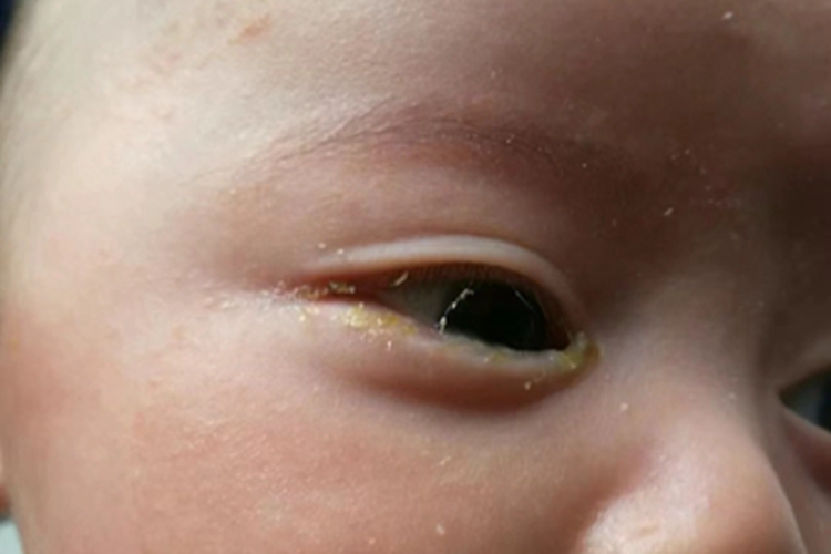 新生儿结膜炎眼睑化脓图