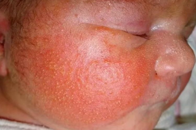 新生儿红斑面部丘疹图