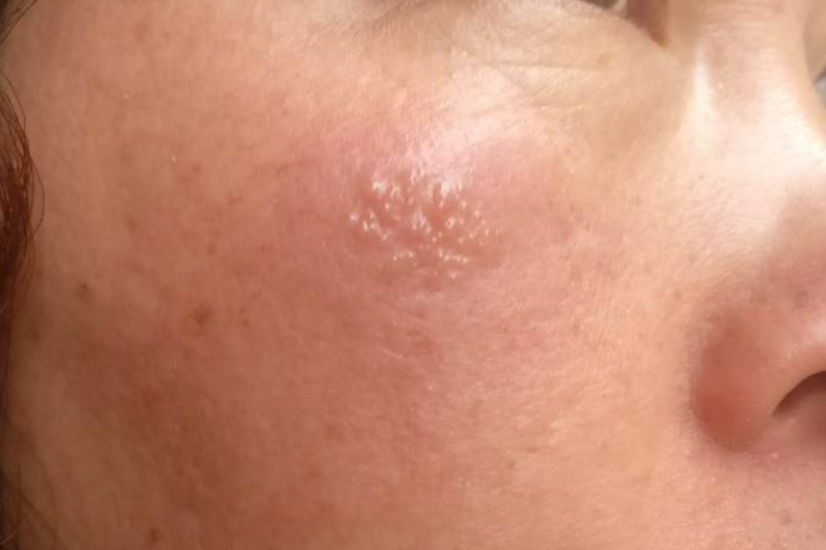 脸上接触性皮炎图