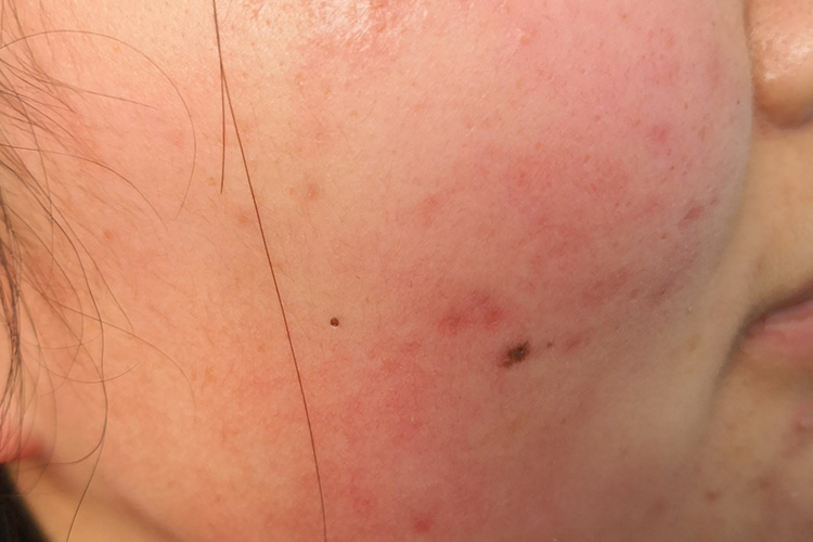 花粉过敏特应性皮炎图