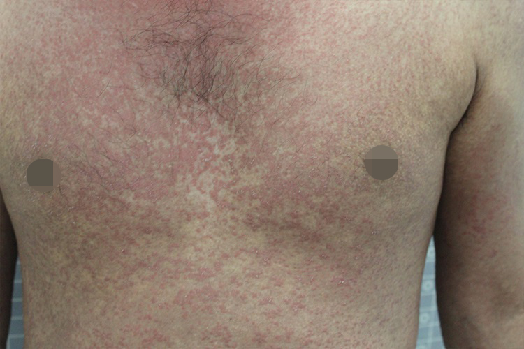 艾滋病初期非感染性皮损图