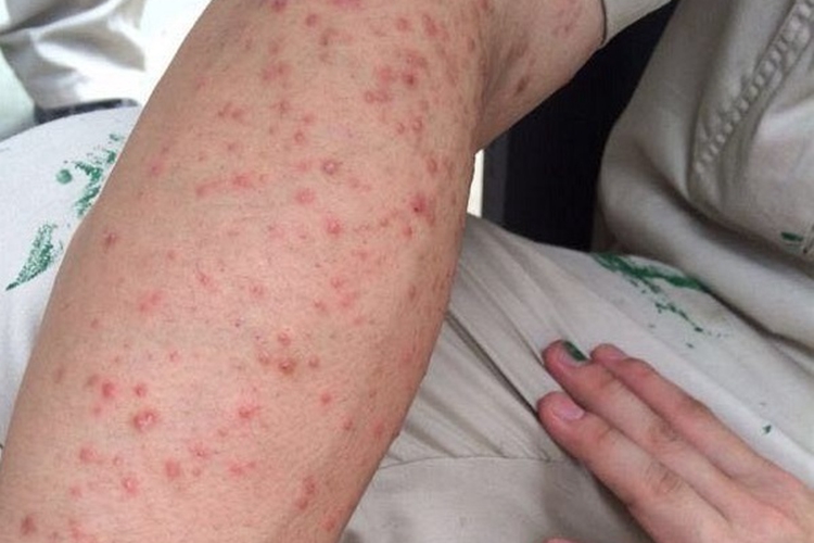 女性三期梅毒小红疙瘩图 女性三期梅毒小红疙瘩图