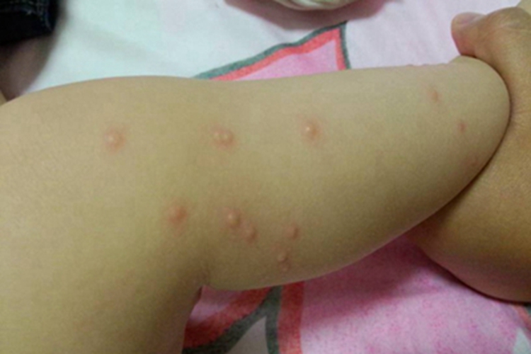 手足口病小腿疙瘩图