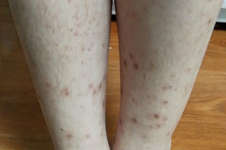 过敏性紫癜棕褐色斑图 过敏性紫癜棕褐色斑图