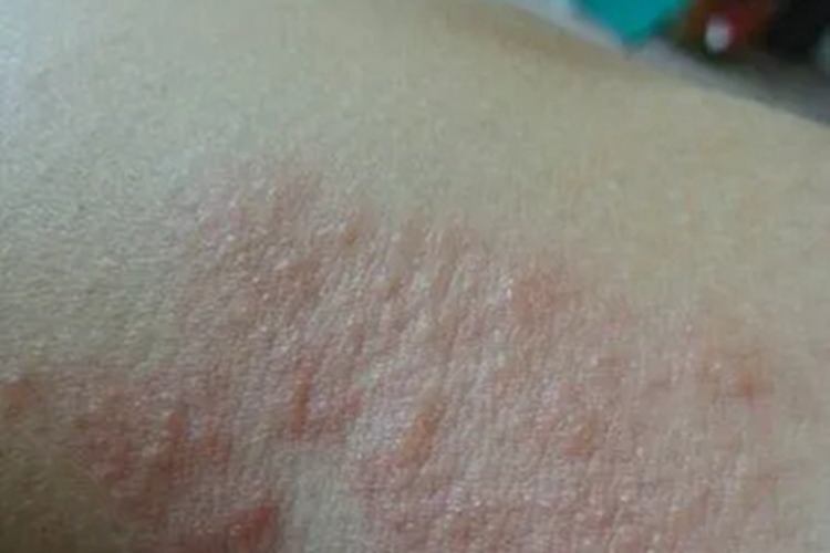 柯萨奇病毒疹胳膊小水疱图