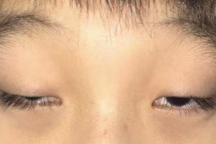 先天性睑裂狭小综合征眼部畸形图 先天性睑裂狭小综合征眼部畸形图