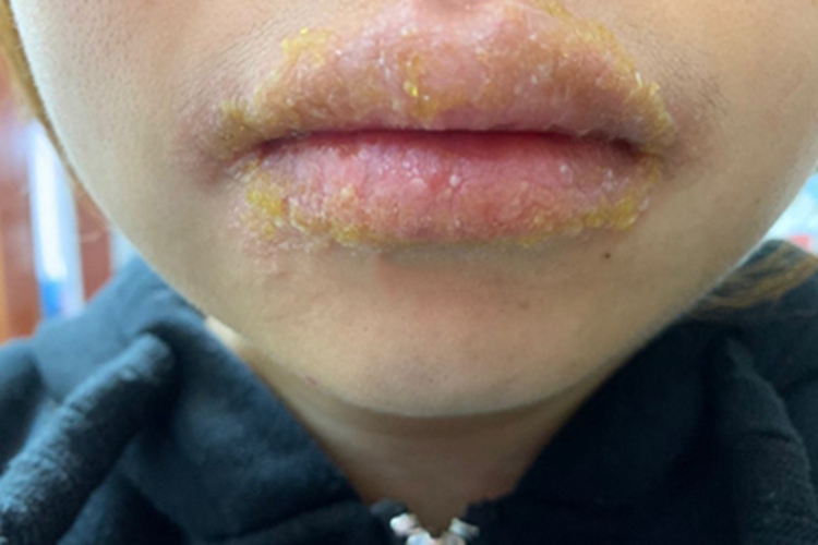 口唇疱疹嘴唇全是黄痂图