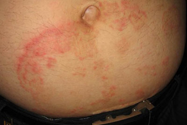 体癣下腹症状图 体癣下腹症状图