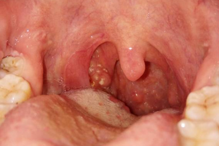 咽部黏膜白斑图