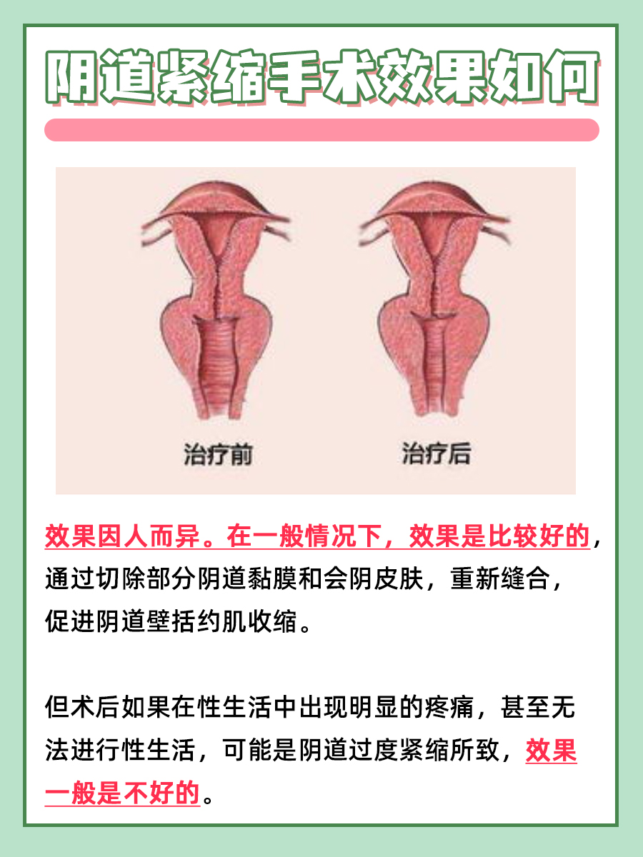 阴道紧缩手术的效果好吗？一文解析