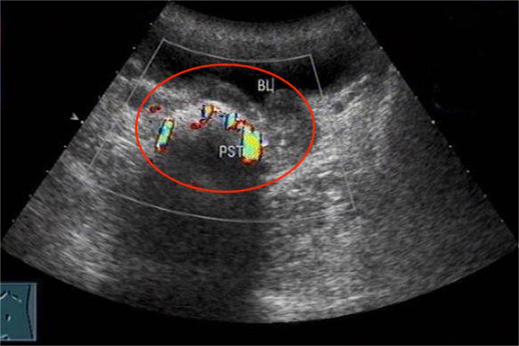 前列腺结石影像图