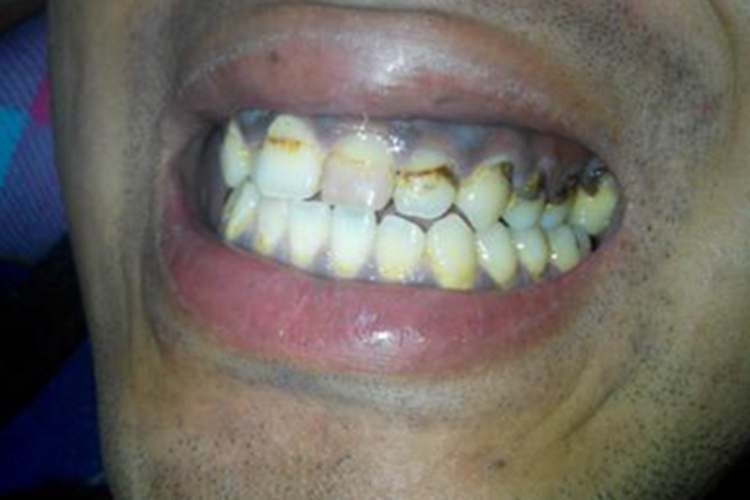 重度四环素牙牙齿条纹图 重度四环素牙牙齿条纹图