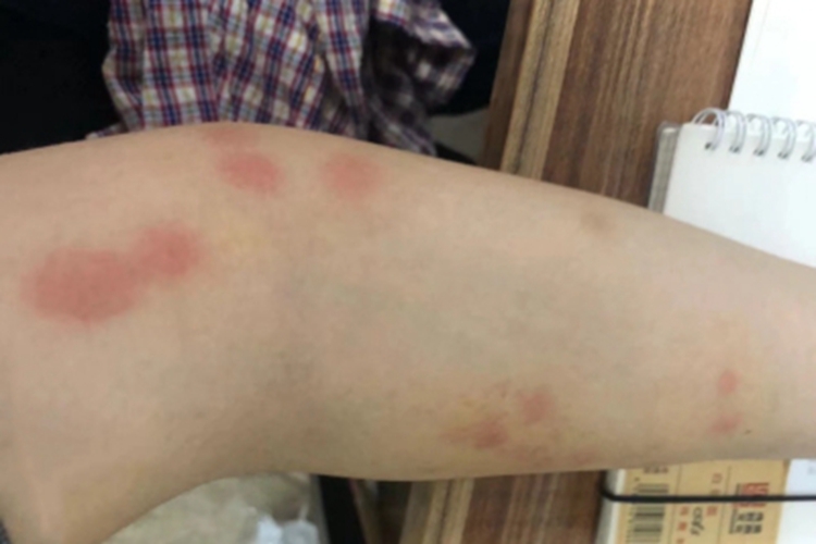 螨虫皮炎胳膊有红斑图 螨虫皮炎胳膊有红斑图