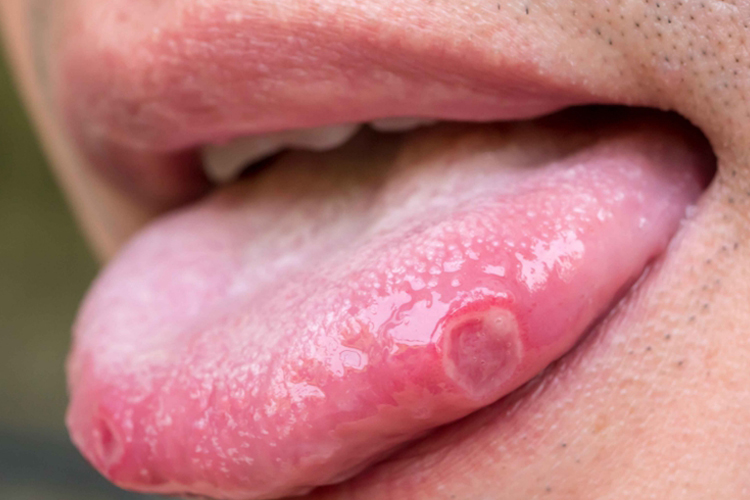 心火旺舌苔图 心火旺舌苔图