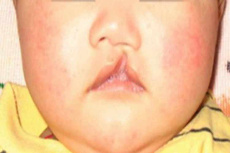 先天性风疹综合征上嘴唇有裂缝图