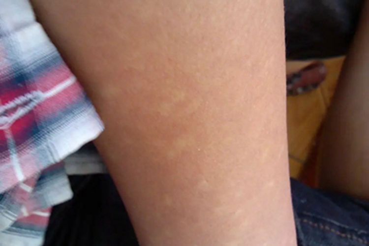 白癜风胳膊白点图 白癜风胳膊白点图