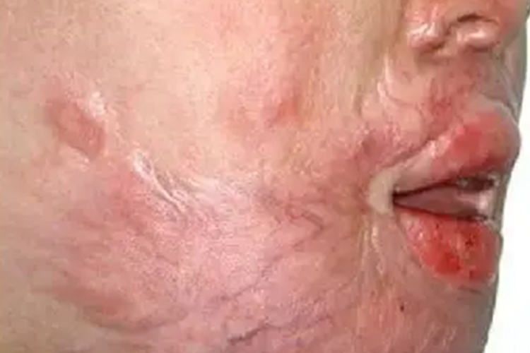 深Ⅱ度烫伤面部瘢痕图 深Ⅱ度烫伤面部瘢痕图