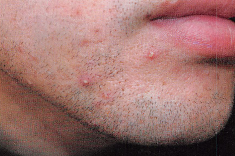 面部毛囊炎 面部毛囊炎