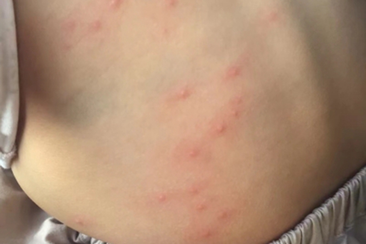 虫咬皮炎腰部疙瘩图