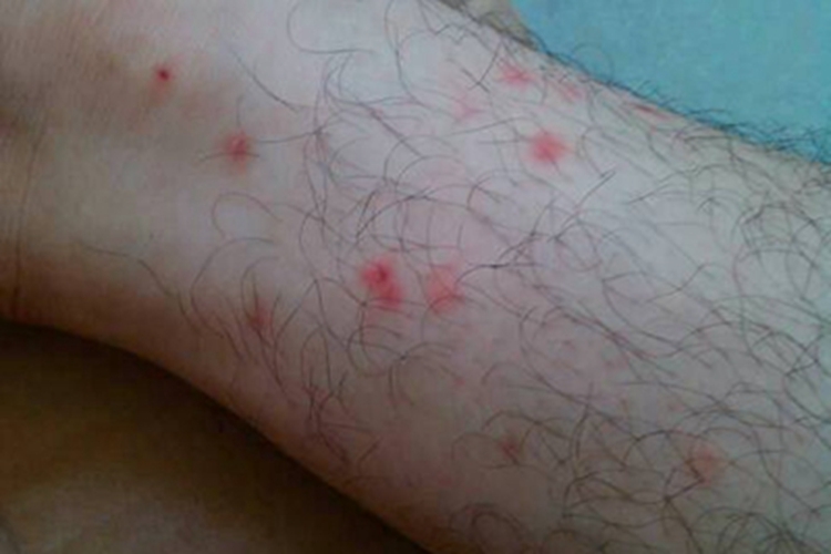 桑毛虫皮炎红点图 桑毛虫皮炎红点图