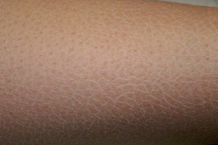 皮肤干燥症小腿脱皮裂纹图 皮肤干燥症小腿脱皮裂纹图