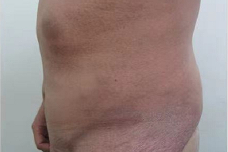 红斑性皮肤松弛症臀部皮肤萎缩图 红斑性皮肤松弛症臀部皮肤萎缩图