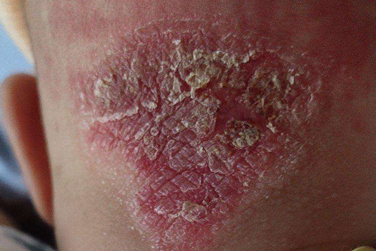 婴儿后脑勺渗出型湿疹图