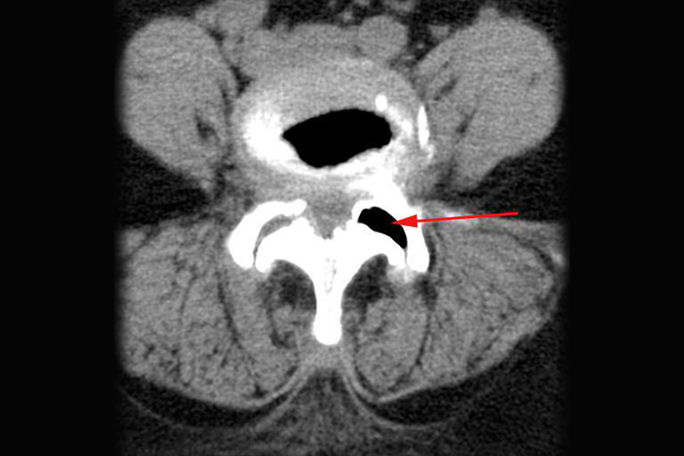 腰椎小关节紊乱关节内积液图