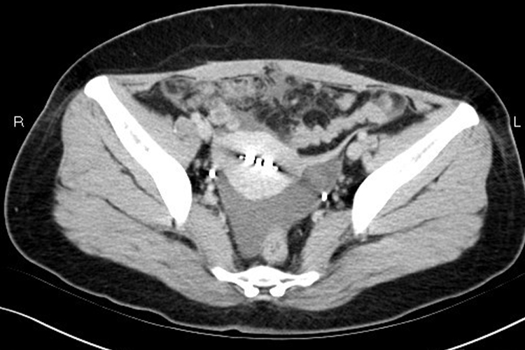 病理性盆腔积液CT平扫图 病理性盆腔积液CT平扫图