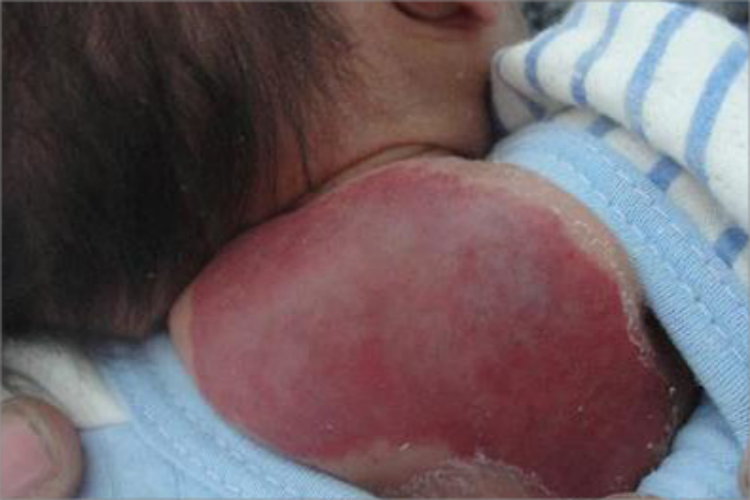 海绵状血管瘤背部症状图