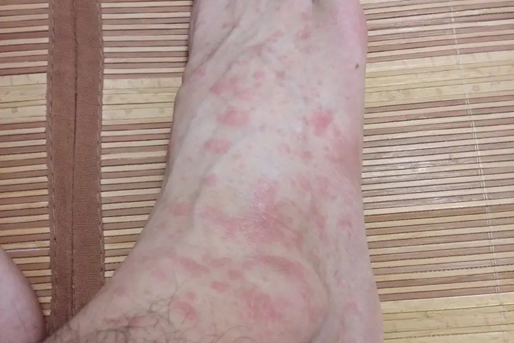皮肤过敏红肿脚部疙瘩图 皮肤过敏红肿脚部疙瘩图
