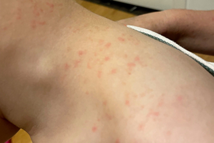 红痱肩膀很多小红点图 红痱肩膀很多小红点图