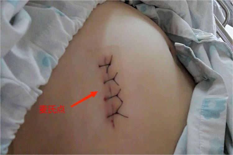 阑尾炎开腹手术伤口图