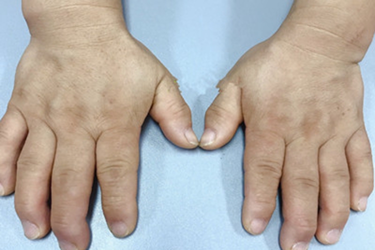 肢端肥大症变形图 肢端肥大症变形图