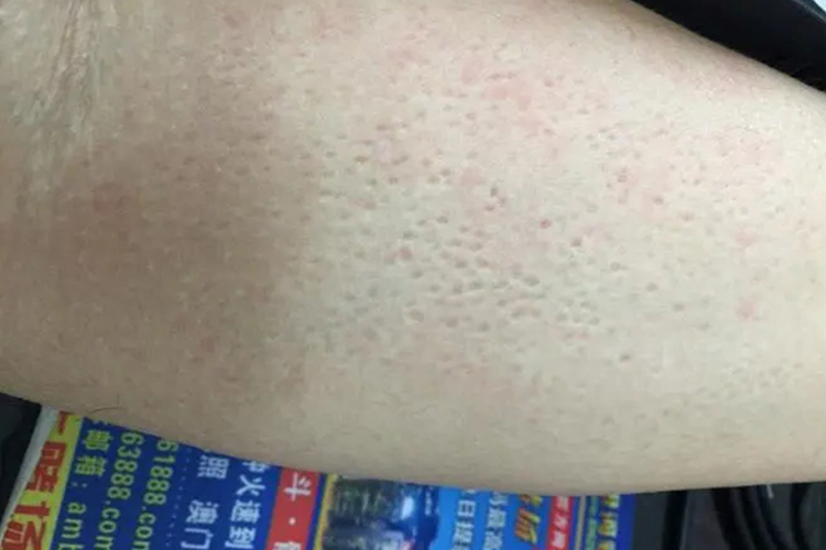 胳膊毛囊角化病图 胳膊毛囊角化病图