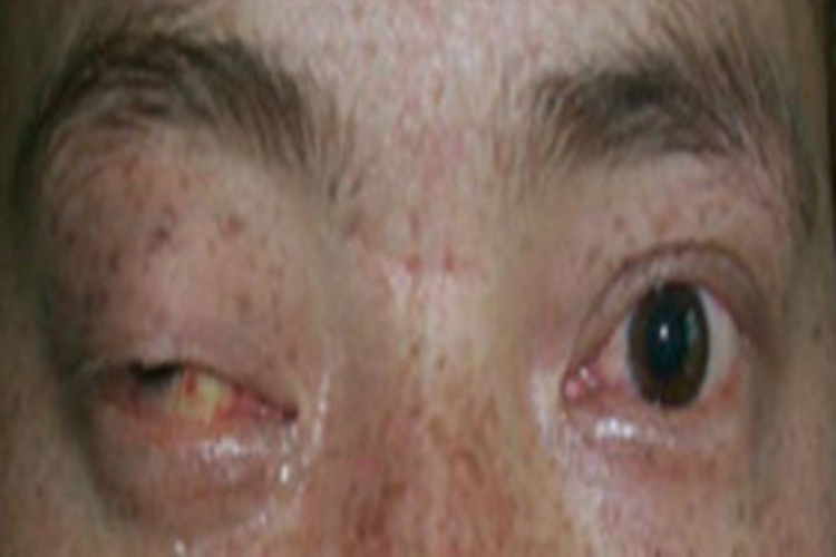 眼眶横纹肌肉瘤眼部化脓图