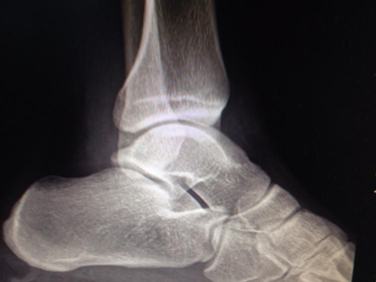 脚踝X光图 脚踝X光图