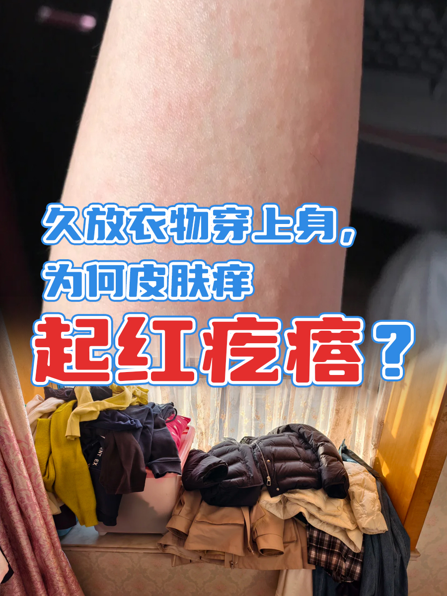 久放衣物穿上身,为何皮肤痒起红疙瘩?