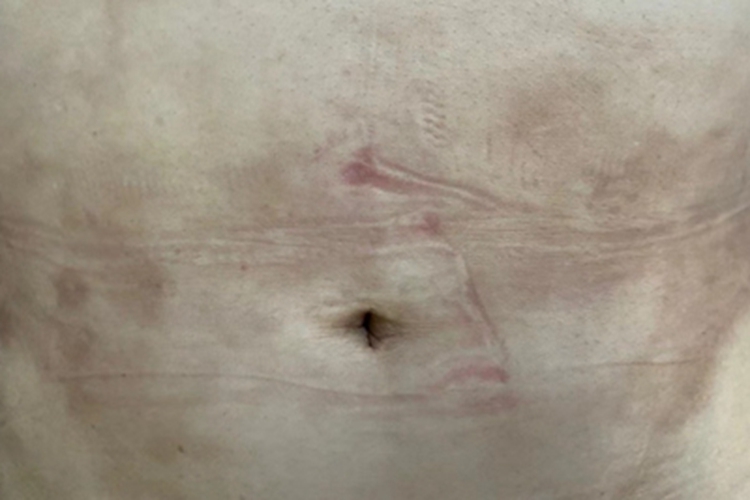 慢性期硬化性脂膜炎症状图 慢性期硬化性脂膜炎症状图