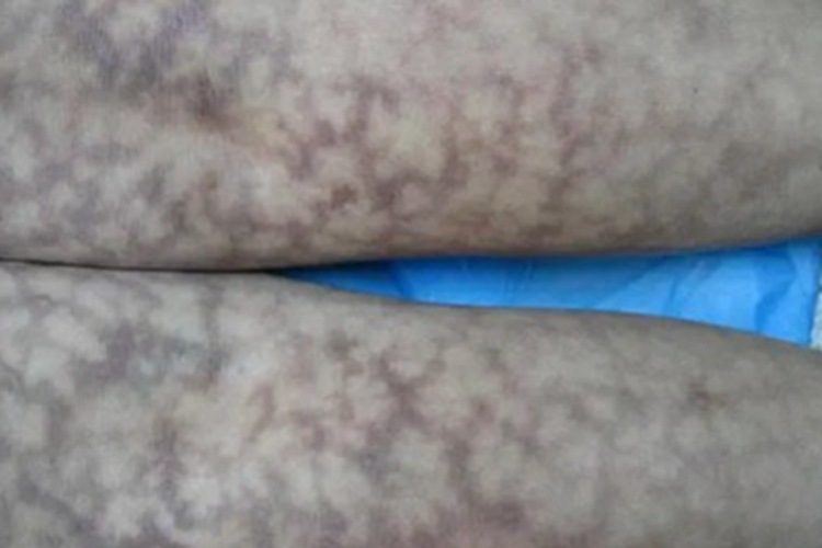 毛细血管扩张性大理石皮肤病斑图