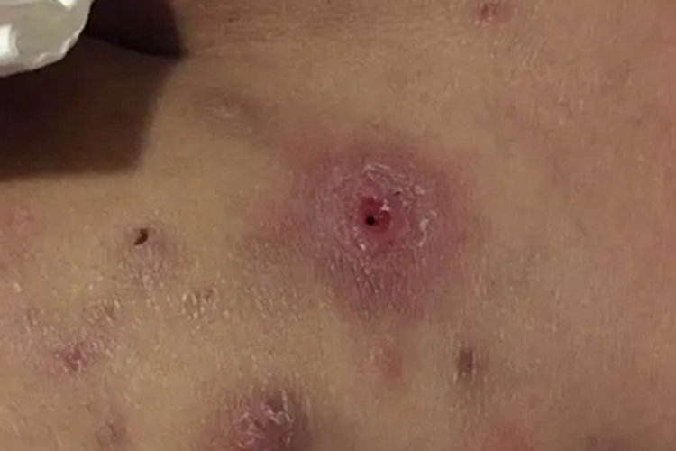 坐板疮臀部硬疙瘩图 坐板疮臀部硬疙瘩图