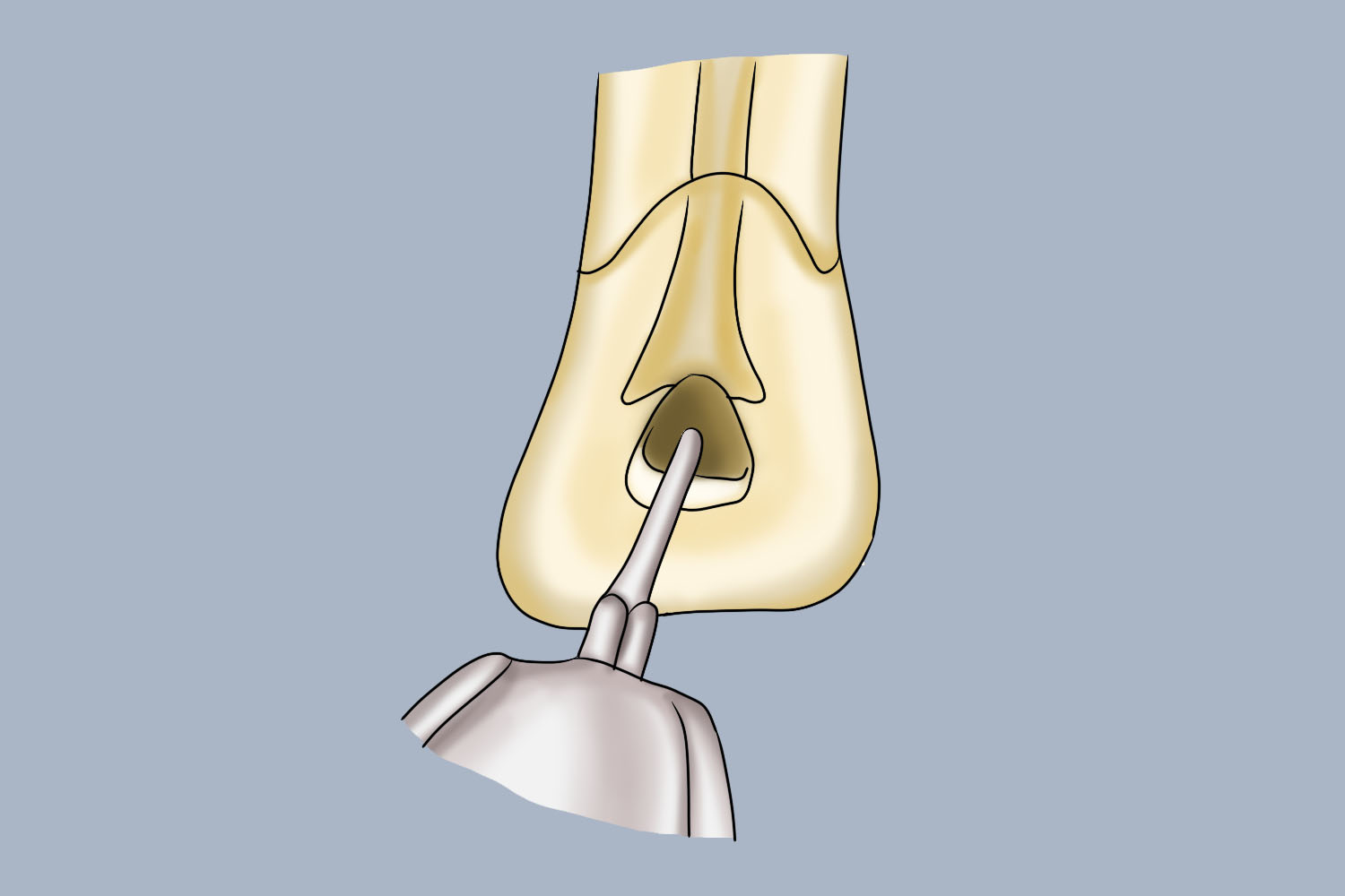 上颌前牙开髓洞形图