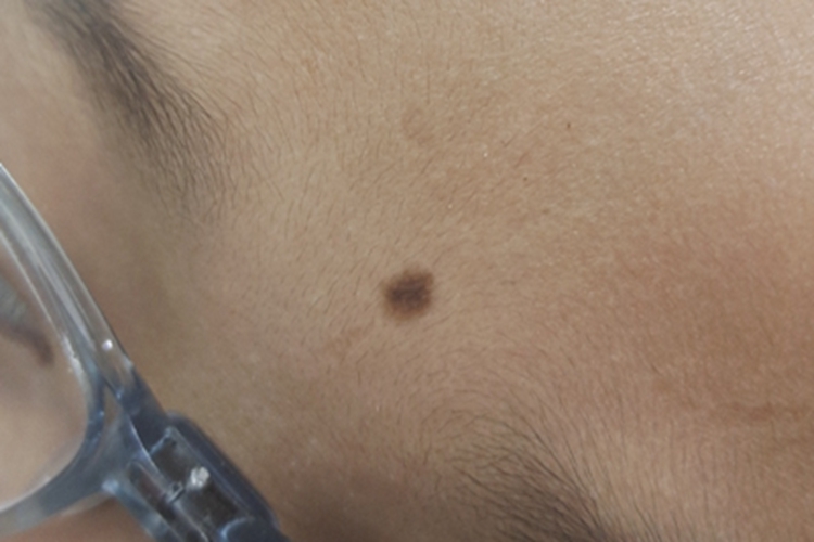 交界痣前额斑疹图 交界痣前额斑疹图