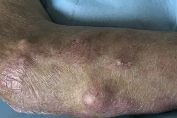 皮肤猪囊尾蚴病大包图