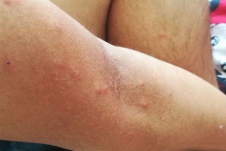 跳蚤叮咬胳膊长小疙瘩图