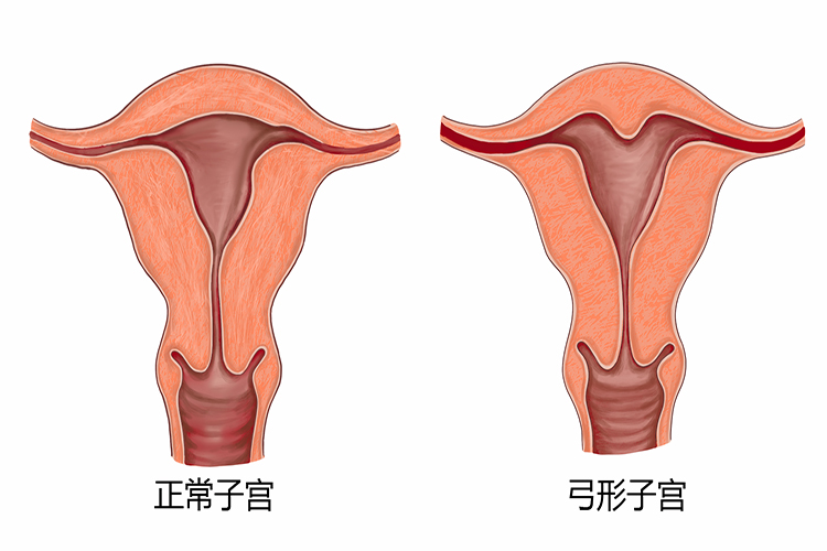 弓形子宫图
